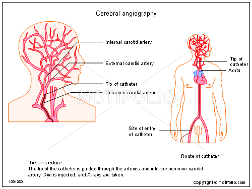 Cerebral Angiography