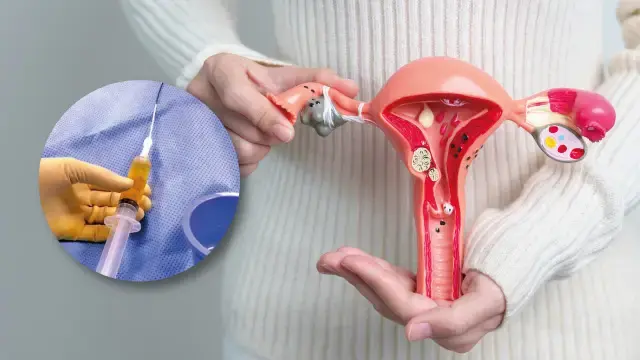 Alcohol Ablation For Ovarian Cysts