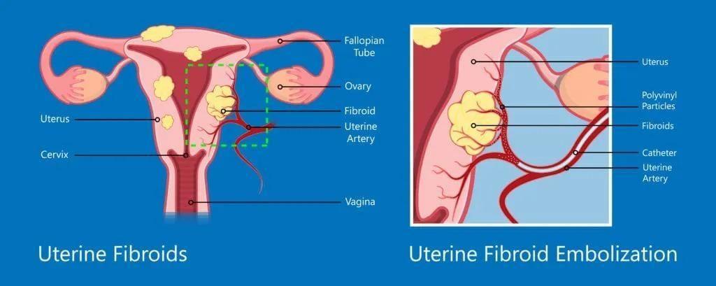 Uterine Fibroid Embolization (UFE)