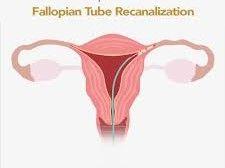 Fallopian Tube Recanalization